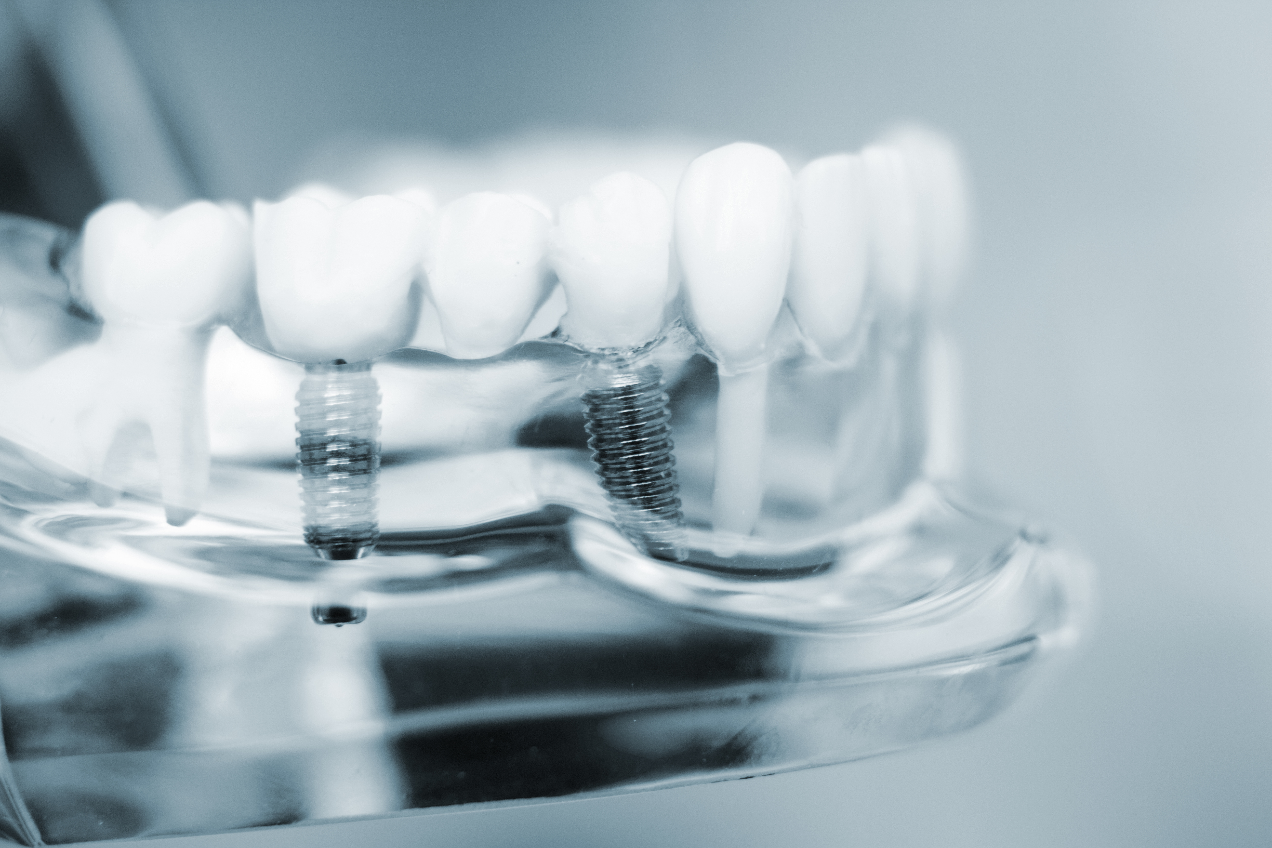 Dental Implants in Bryant